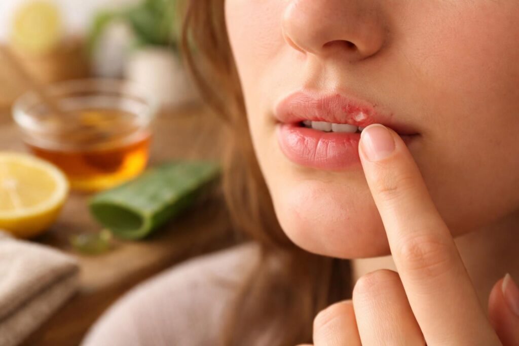 découvrez des remèdes maison efficaces pour soulager rapidement la douleur causée par un bouton de fièvre et retrouver votre confort.