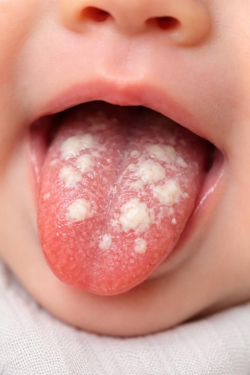 découvrez les symptômes du muguet chez le bébé pour reconnaître rapidement cette infection et agir efficacement afin d'assurer le confort et la santé de votre enfant.