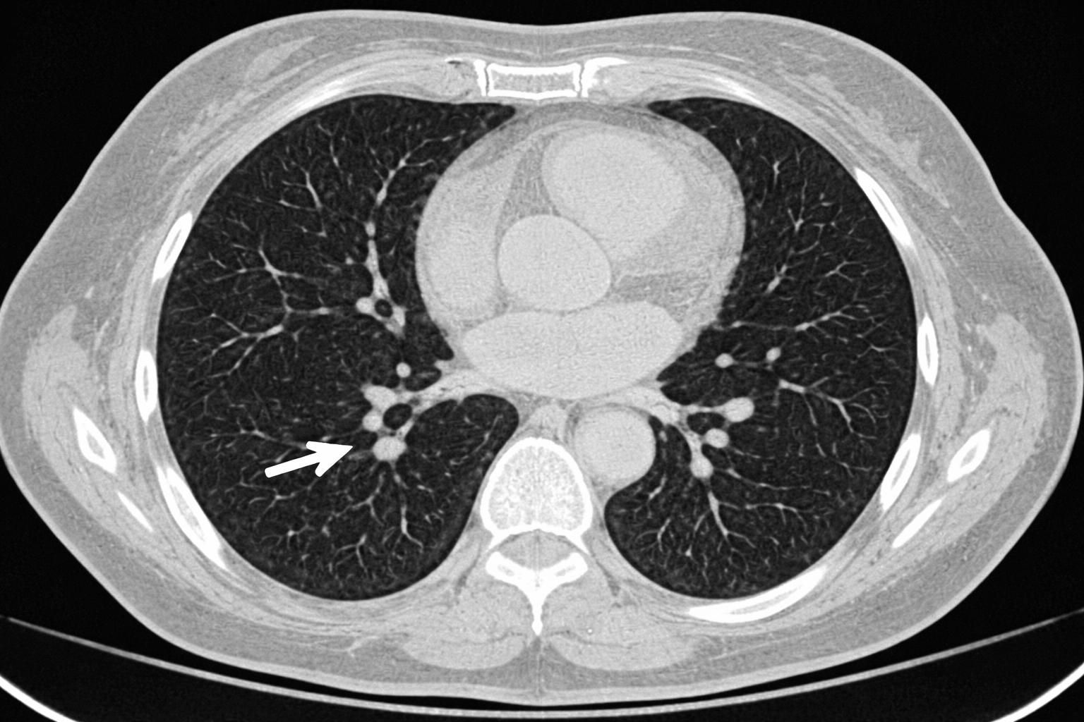 découvrez les symptômes clés des nodules pulmonaires qui nécessitent une consultation médicale rapide pour un diagnostic et un traitement appropriés.